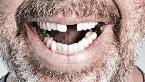 الأسنان المُقتَلَعة أو التي تم إسقاطها